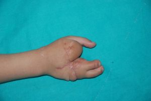 Ayaktan-Ele-Parmak-Nakli-1-1024x685-1-300x201