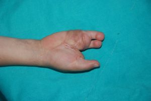 Ayaktan-Ele-Parmak-Nakli-2-1024x685-1-300x201 (1)