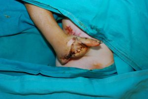 Ayaktan-Ele-Parmak-Nakli-3-1024x685-1-300x201