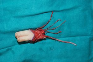 Ayaktan-Ele-Parmak-Nakli-5-1024x685-1-300x201