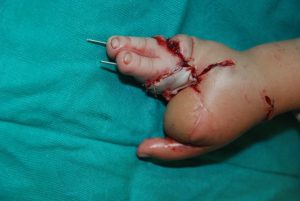 Ayaktan-Ele-Parmak-Nakli-6-1024x685-1-300x201