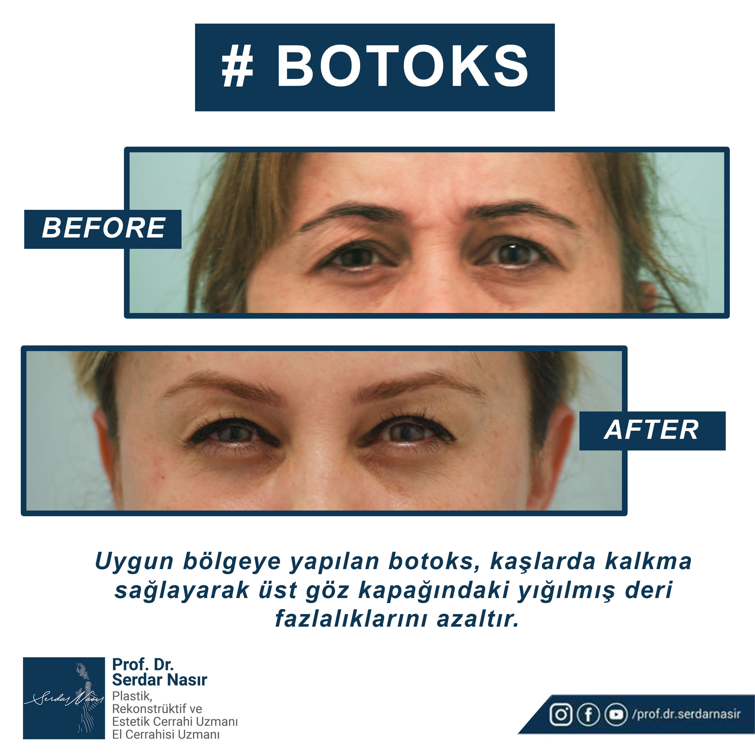 botoks (3)