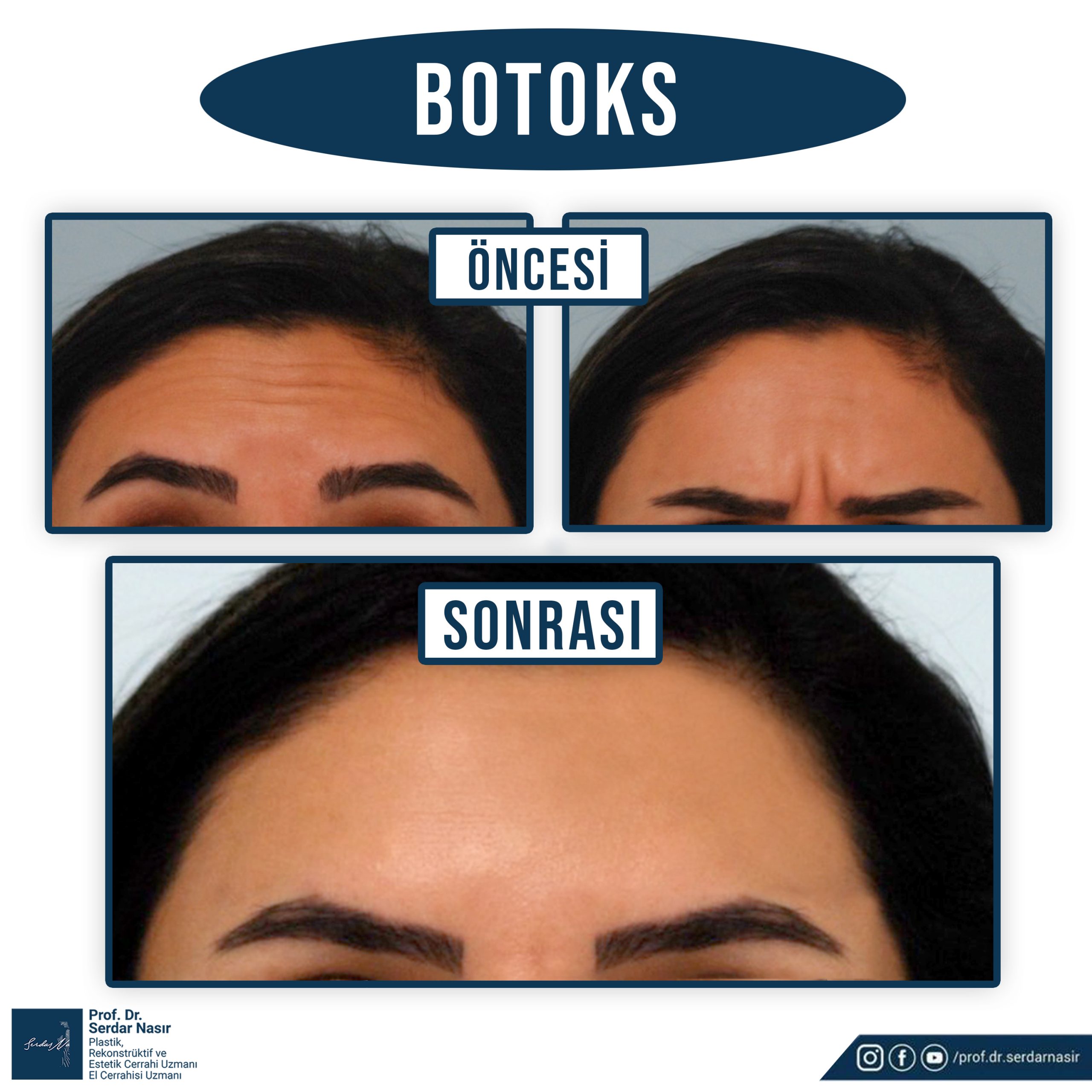 botoks